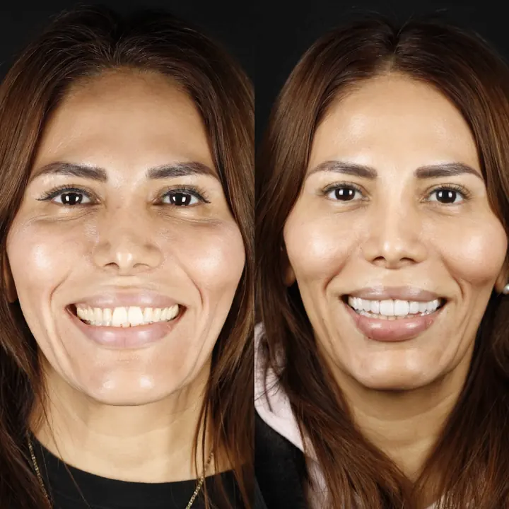 Antes y después de carillas de porcelana de Cinthia Almeda, paciente en Monterrey