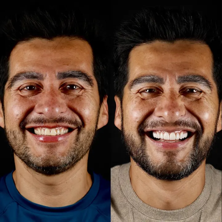 Antes y después de carillas de porcelana de Francisco Hernández, paciente en Monterrey