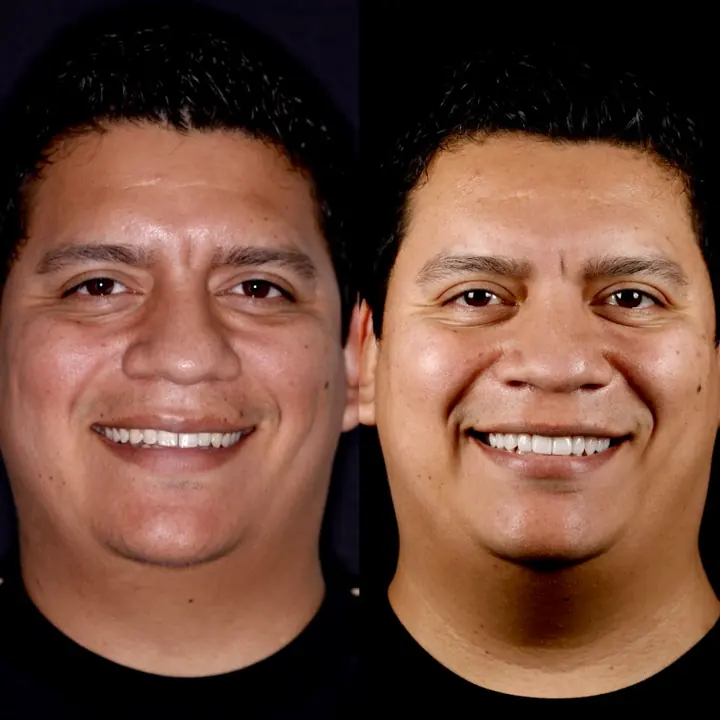 Antes y después de carillas de porcelana de Javier Durón, paciente en Monterrey