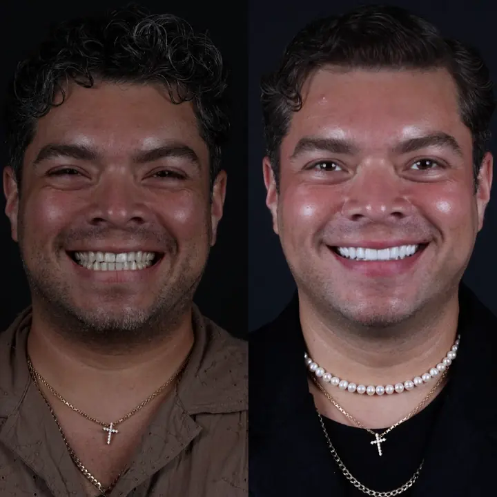 Antes y después de carillas de porcelana de Jekyll Arce, paciente en Monterrey