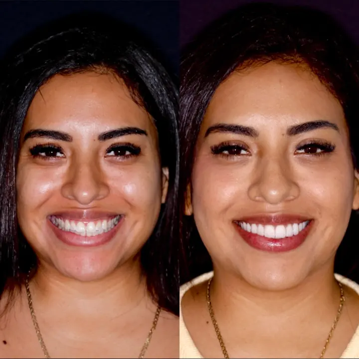 Antes y después de carillas de porcelana de Lesli Gabriela, paciente en Monterrey
